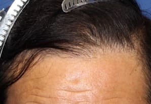 植毛10ヶ月後63歳 男性 F.S.さん生え際 MIRAI法 1,600株 東京 新宿院