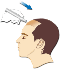 空気圧を利用して毛髪を移植